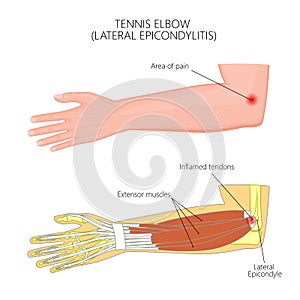 Lateral Epicondylitis or tennis elbow photo