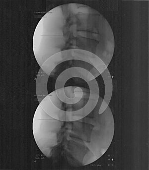 Lateral Epidural Injection photo