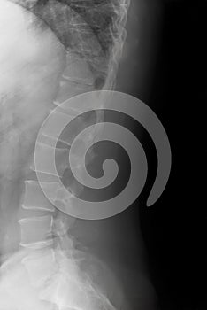 Lateral Lumbar Curve