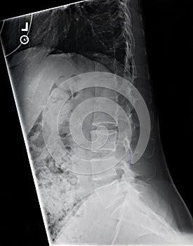 Lateral Lumbar Spine photo