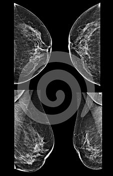 Lateral mammogram of female breast