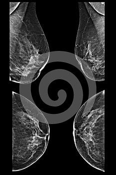 Lateral mammogram of female breast