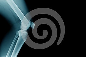 Lateral view of human knee joint