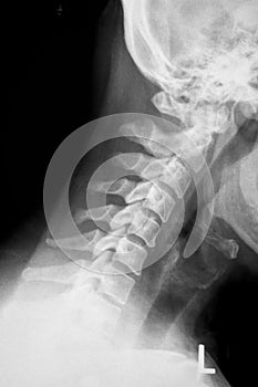 Lateral x-ray of c-spine photo