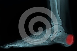 Lateral x-ray of foot and ankle. the film show normal bone and joint. the patient has Achilles tendinitis and retrocalcaneal photo
