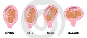 Latin arabian brown skin baby. Different wrong baby positions in uterus during pregnancy.