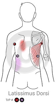 Latissimus dorsi myofascial trigger point and middle back pain