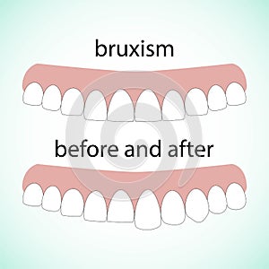 Layout attrition Bruxism teeth illustration vector. Erased teeth. Restoration of teeth. Dental concept