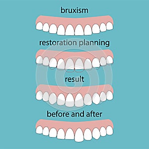 Layout attrition Bruxism teeth illustration vector. Erased teeth. Restoration of teeth. Dental concept