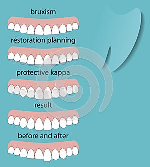 Layout attrition Bruxism teeth illustration vector. Erased teeth. Restoration of teeth. Protective kappa. Dental concept
