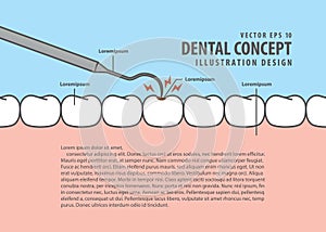 Layout decay tooth check up Caries cartoon style for info or b