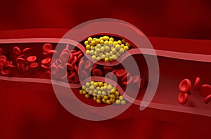 Partly blocked vessel in high level of LDL (bad cholesterol) lipoprotein â isometric view 3d illustration