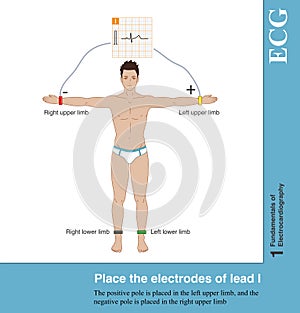 Place the electrodes of lead I