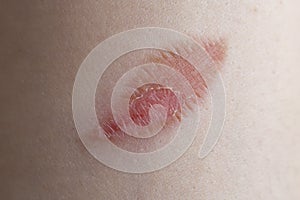 Leaf shaped burn wound on a woman\'s fore arm, macro skin texture