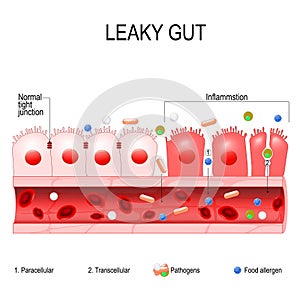 Leaky gut