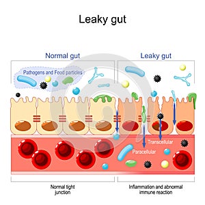 Leaky gut