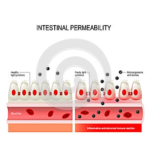 Leaky gut. Intestinal permeability