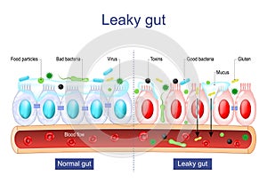 Leaky gut. Intestinal permeability. Gut barrier dysfunction photo