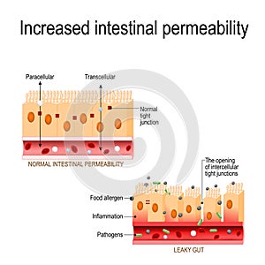 Leaky gut. The opening of intercellular tight junctions increased intestinal permeability photo