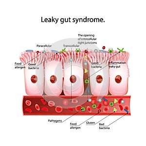 Leaky gut syndrome.