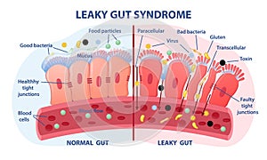 Leaky gut Syndrome concept photo