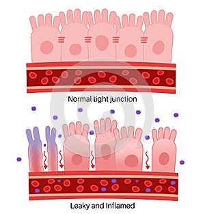 Leaky Gut Syndrome or intestinal hyperpermeability.