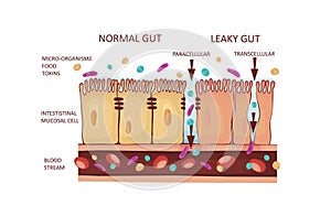 Leaky Gut Syndrome or Intestinal Permeability Diagram. Autoimmune disorder. photo