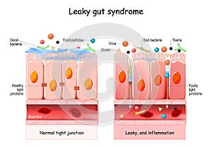 Agujereado intestino síndrome 