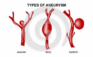 Types of Aneurysms