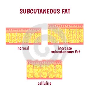 Kože vrstva z podkožný tuk 
