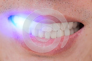 LED laser blue light bleach teeth whitening in male