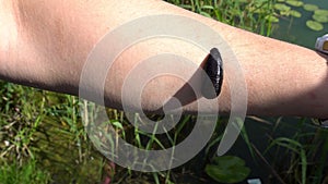 The leech stuck to the arm of a young man