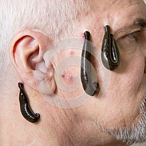 Leech therapy