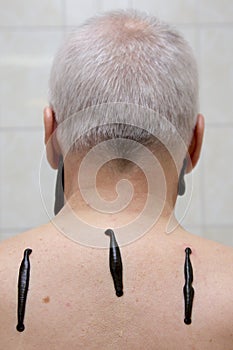 Leech therapy