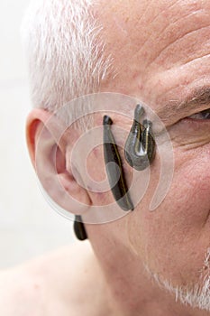 Leech therapy