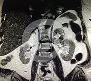 Left adrenal lesion adenoma mri examination photo