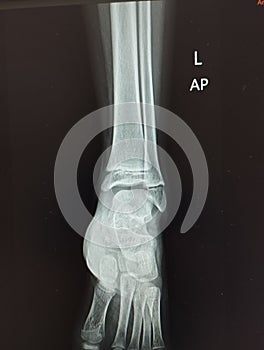 Left ankle x-ray lateral view normal bone and no swelling soft tissue,