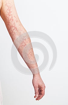 Left arm with red skin capillary network