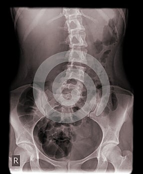 A la izquierda convexo columna vertebral 