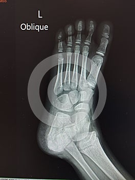 Left foot and ankle x-ray oblique view no bone broken soft tissue swelling, Medical image concept.