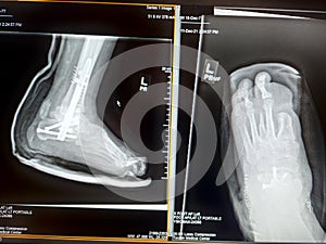 Left foot ray resections and ankle fracture with ORIF