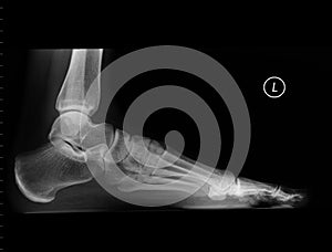 Left foot X-Ray