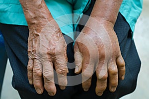 Left hand inflammation photo