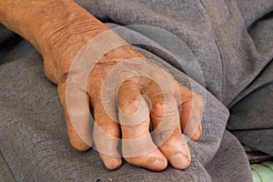 Left hand of a leprosy photo