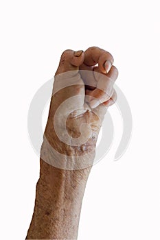 Left hand of a leprosy photo