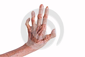 Left hand of a leprosy isolated on white background photo