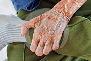 Left hand of a leprosy photo