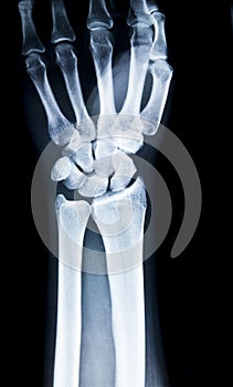 Left hand x-ray