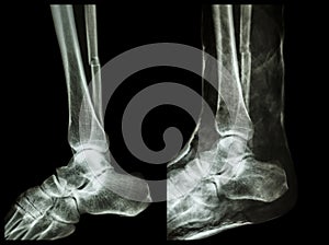 Left image : Fracture shaft of fibula (calf bone) , Right image : It was splinted with plaster cast photo
