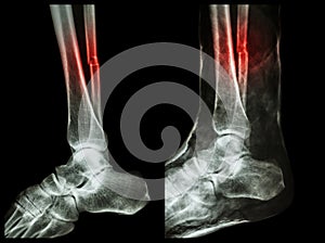 Left image : Fracture shaft of fibula (calf bone) , Right image : It was splinted with plaster cast photo